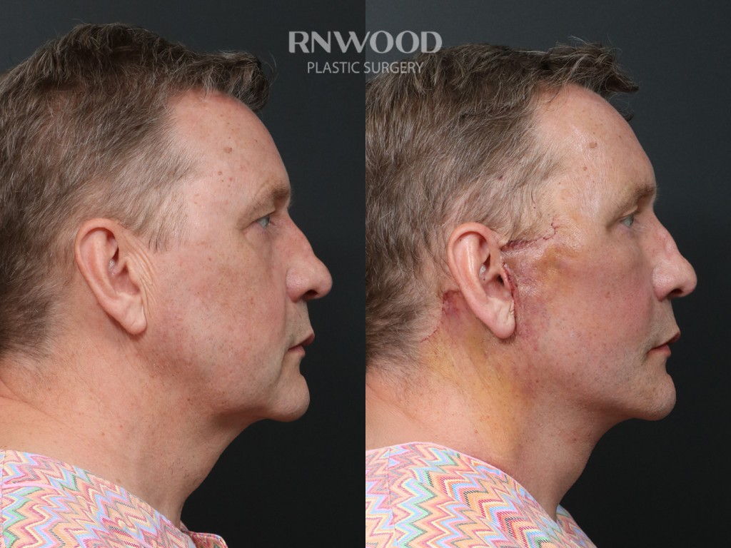Deep Plane Facelift — before and after, profileRight view, case 08