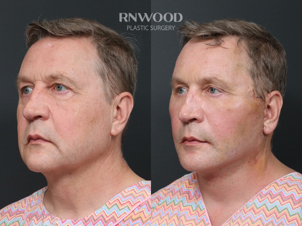 Deep Plane Facelift — before and after, threeQuarterLeft view, case 08