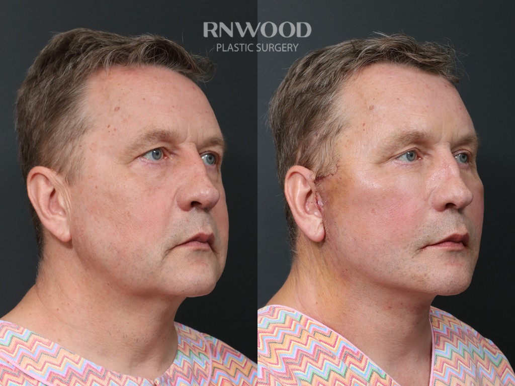 Deep Plane Facelift — before and after, threeQuarterRight view, case 08
