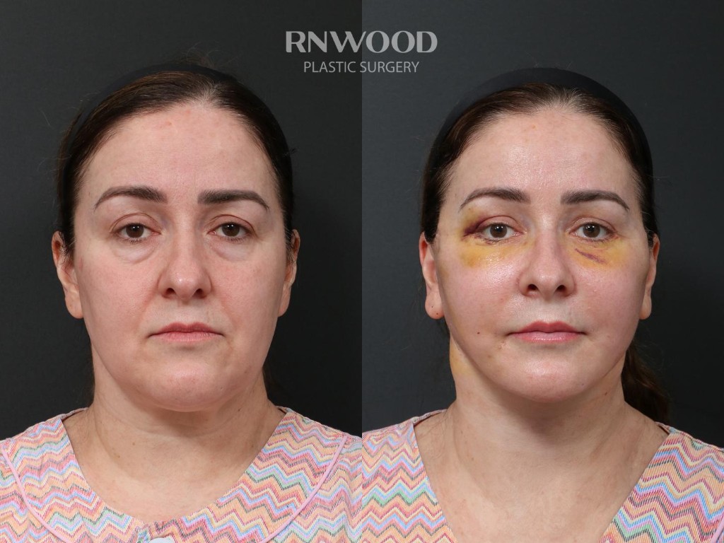 Deep Plane Facelift — before and after, front view, case 09