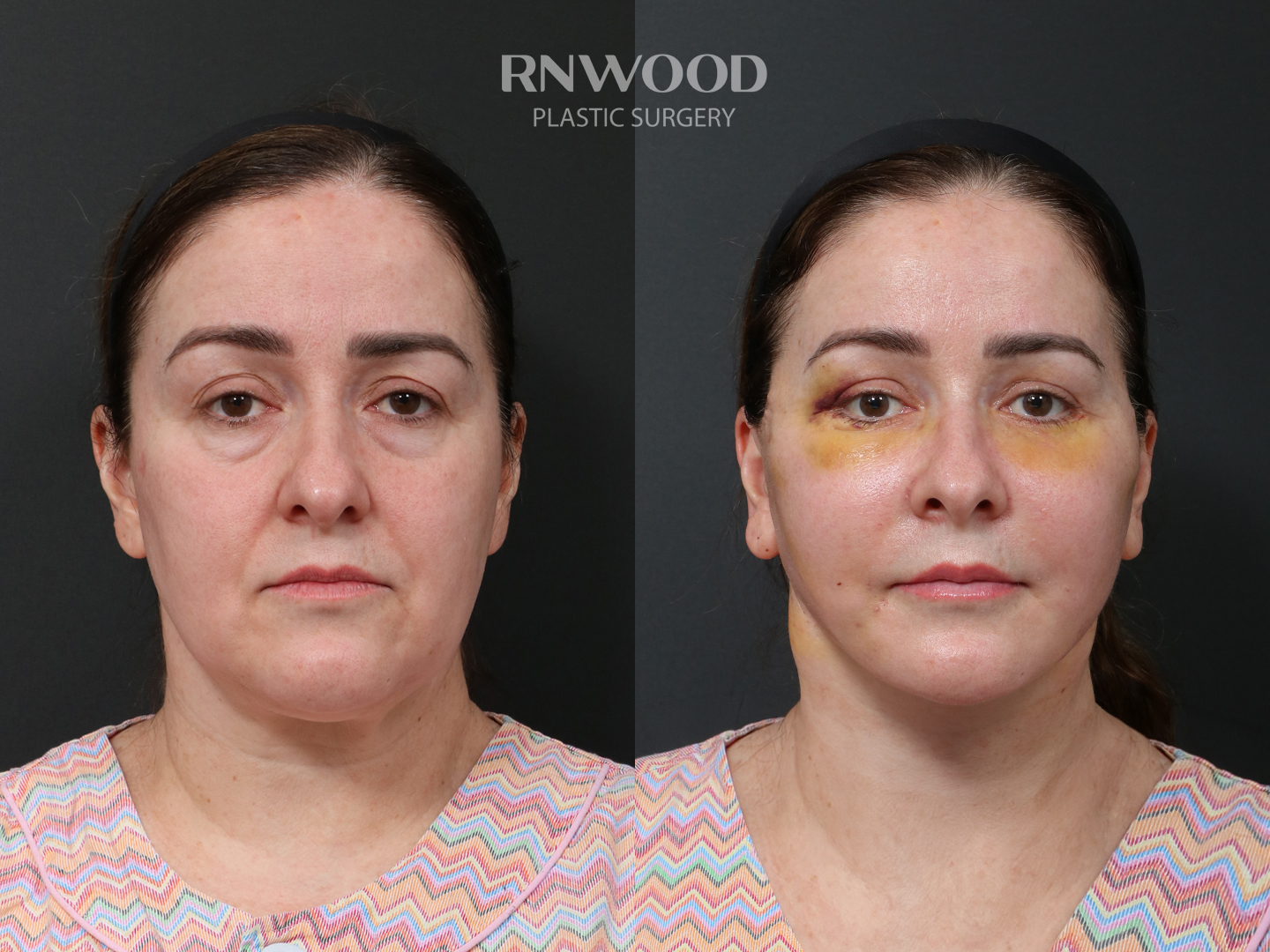 Deep Plane Facelift — before and after, front view, case 02