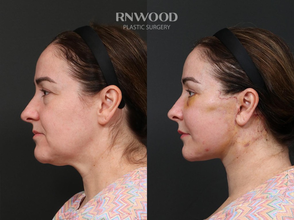 Deep Plane Facelift — before and after, profileLeft view, case 09