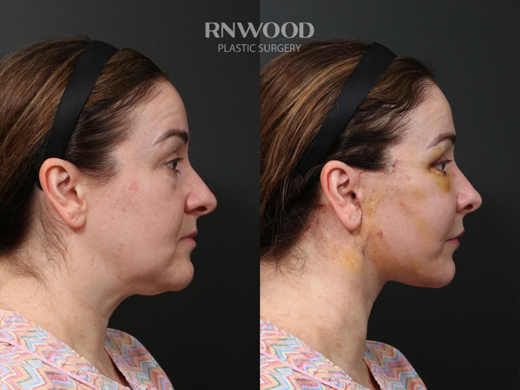 Deep Plane Facelift — before and after, profileRight view, case 09