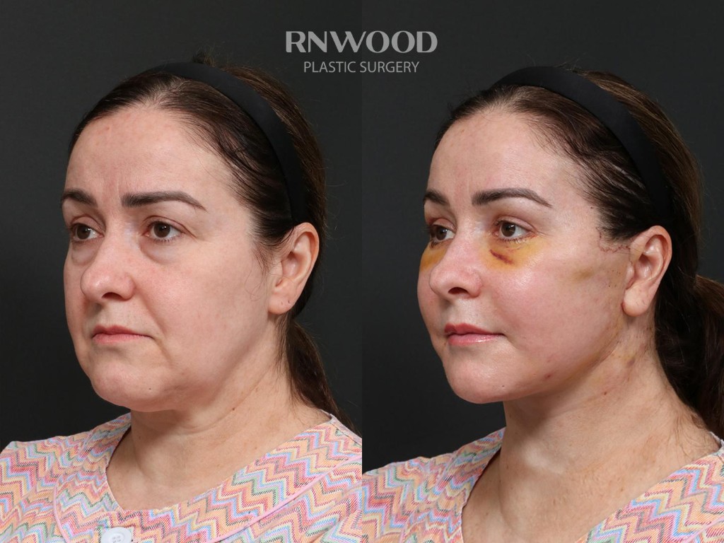 Deep Plane Facelift — before and after, threeQuarterLeft view, case 09