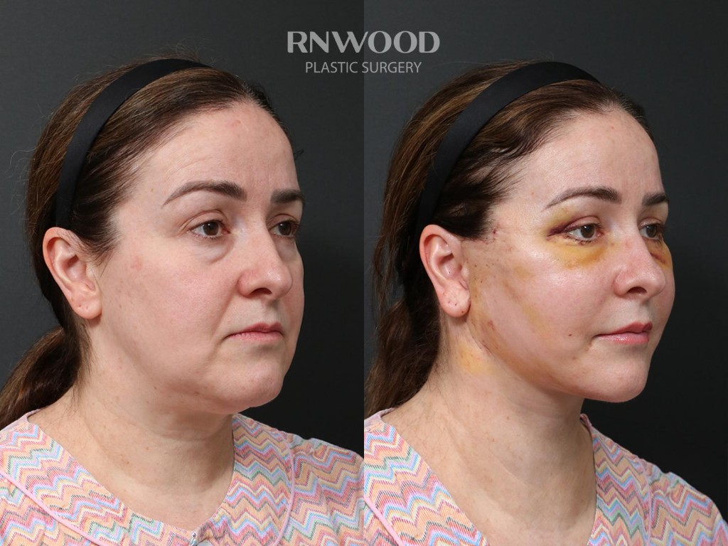 Deep Plane Facelift — before and after, threeQuarterRight view, case 09