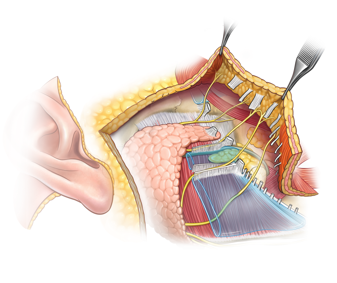 Deep Plane facelift dissection — SMAS flap elevated, retaining ligaments released, facial nerve branches preserved