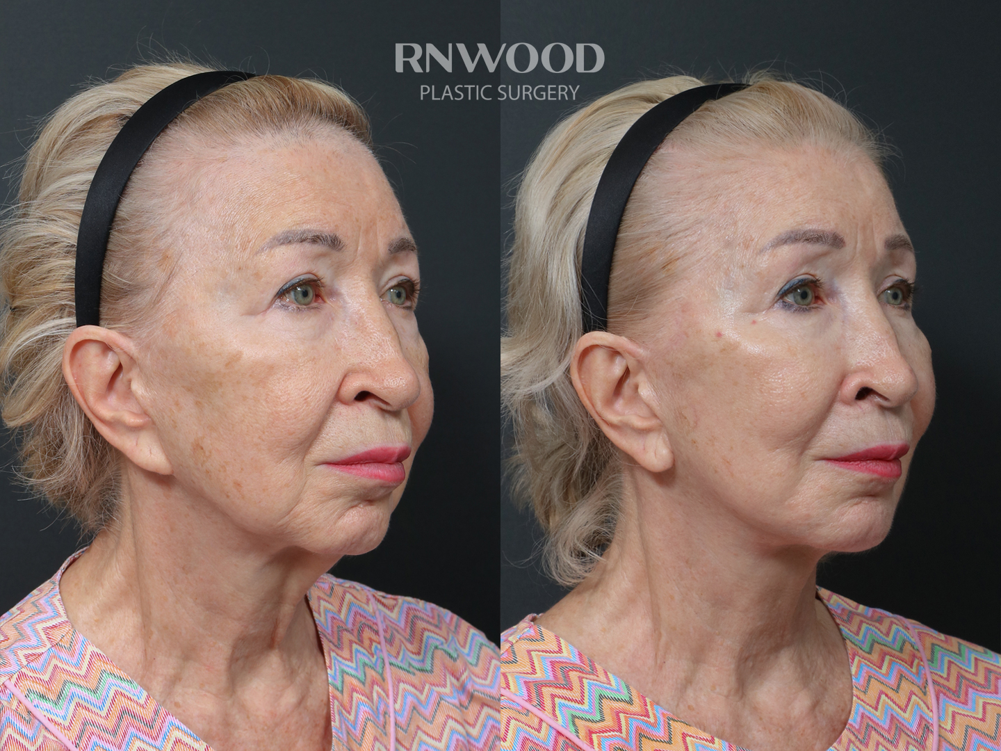Revision Deep Plane Facelift — before and after, threeQuarterRight view, case 04