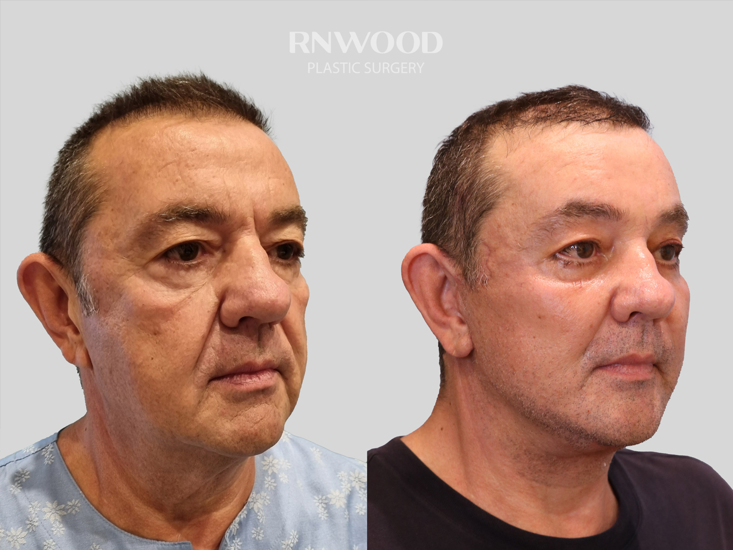 Deep Plane Facelift — before and after, threeQuarterRight view, case 08