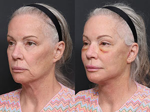Deep-Plane-Face-and-Neck-Lift