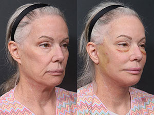 Lower-Blepharoplasty