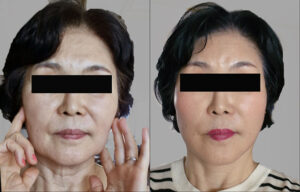 deep plane facelift, neck lift, and forehead lift