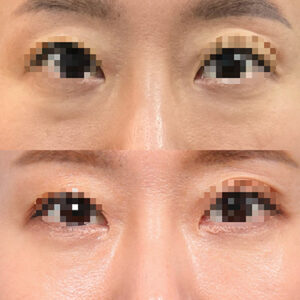 under eye surgery