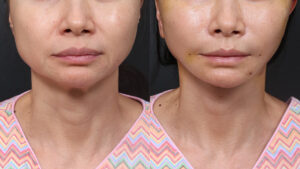deep plane face and neck lift