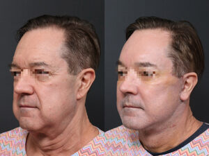 deep plane facelift, neck lift, lower eyes