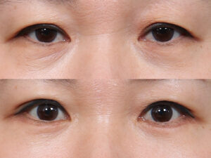 eyelid surgery