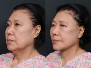 Face,Neck lift, Fat grafting, and Submentoplasty